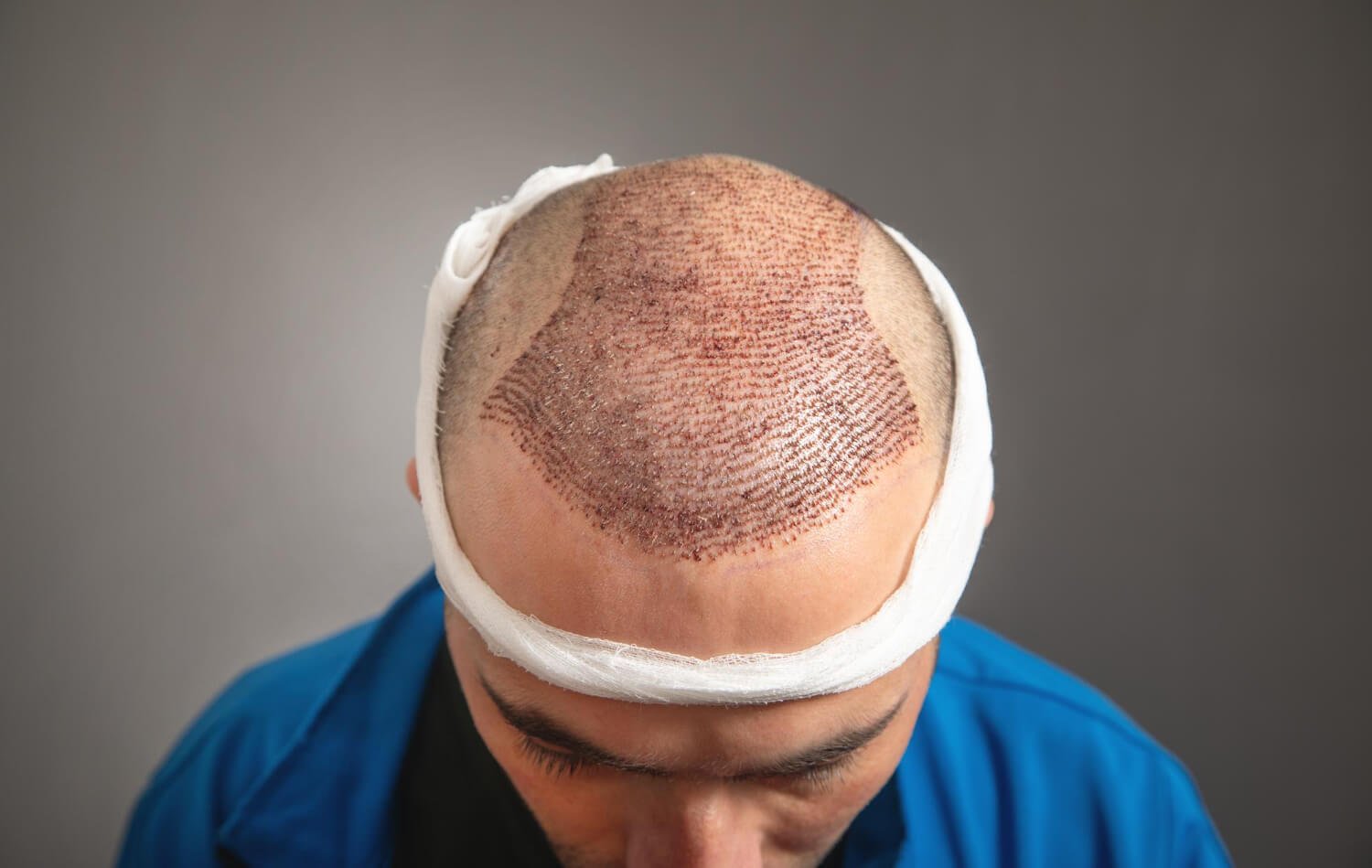 Hair Transplant Cost in Dubai: 2026 Price Guide by Technique